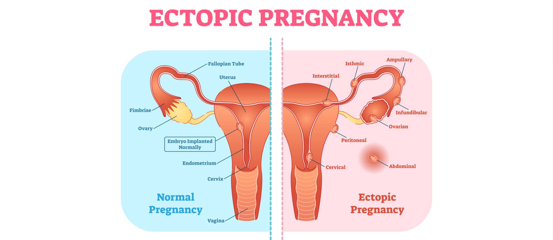 ectopic pregnancy treatment in utsav fertility center in panvel, navi mumbai