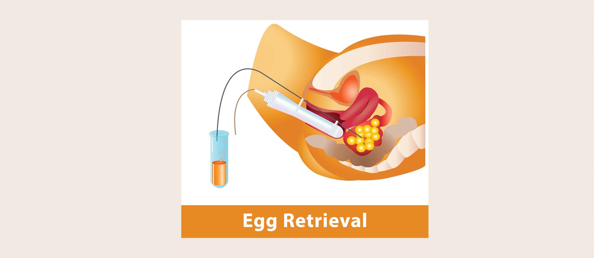 egg retrival in utsav fertility center in panvel, navi mumbai