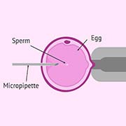intracytoplasmic sperm injection (icsi) treatment in utsav fertility center in panvel, navi mumbai