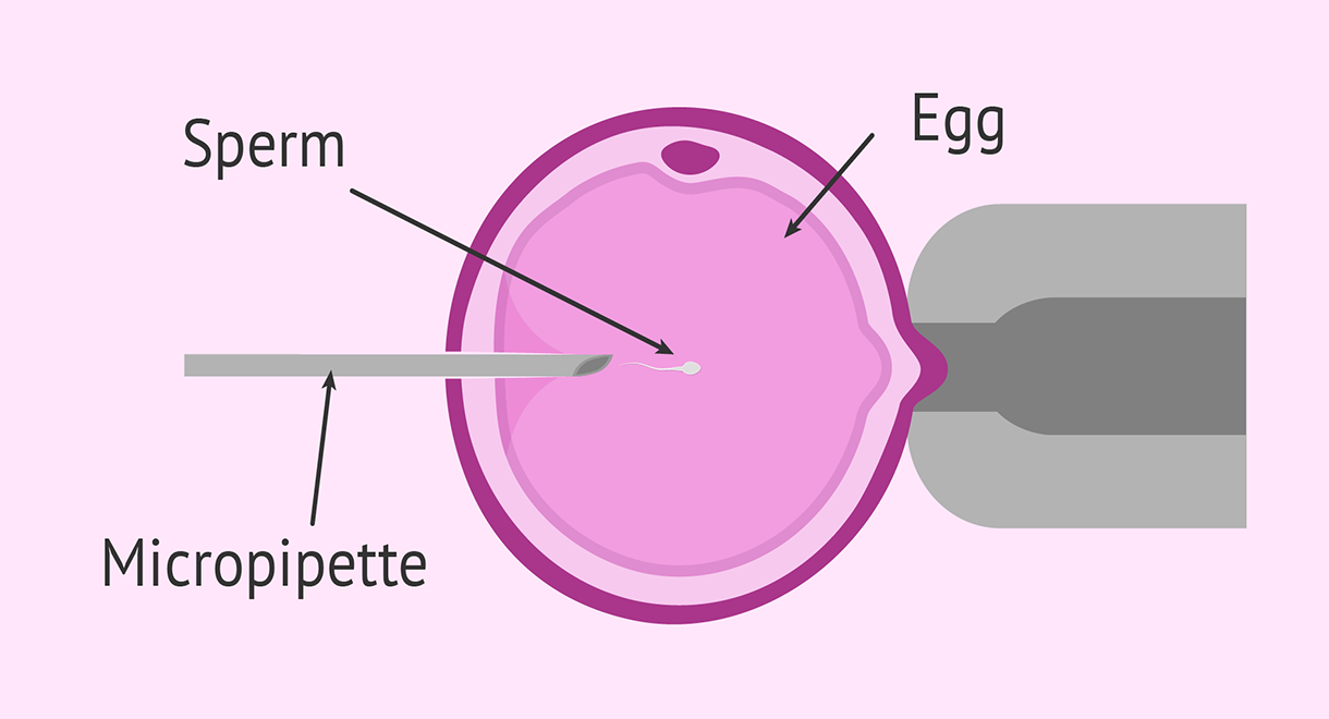 intracytoplasmic sperm injectio in utsav fertility center in panvel, navi mumbai